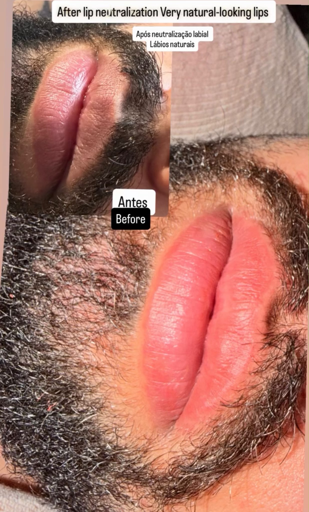 Original before and after lip neutralisation comparison