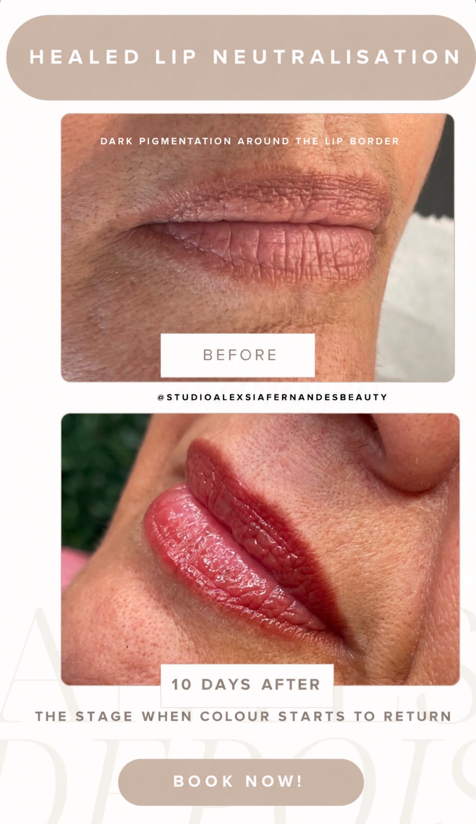 Original lip neutralisation comparison showing before and ten days after